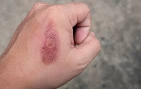 Pengertian Luka Bakar